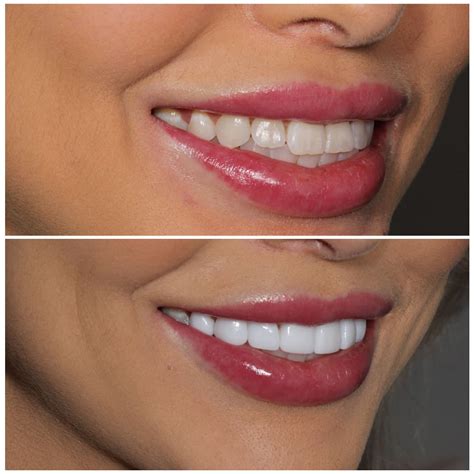 Transformation with Porcelain Veneers: Before and After .